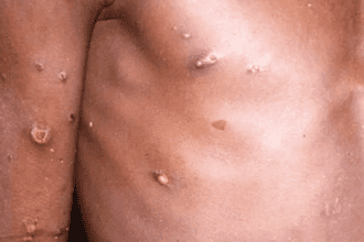   Viruela símica: Salud confirma dos casos activos en San José