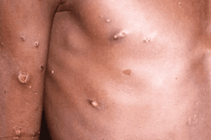   Viruela símica: Salud confirma dos casos activos en San José