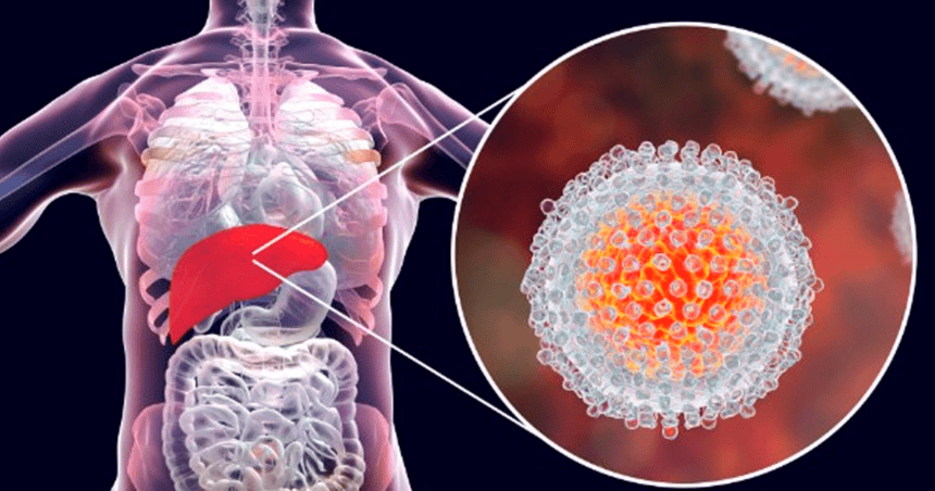¡Alerta sanitaria! Alarmante aumento de casos de hepatitis A azota al país